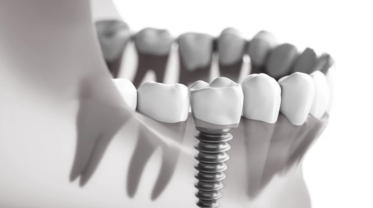 Çorlu'da Tek Seansta İmplant (same-day Implant) Mümkün Mü?