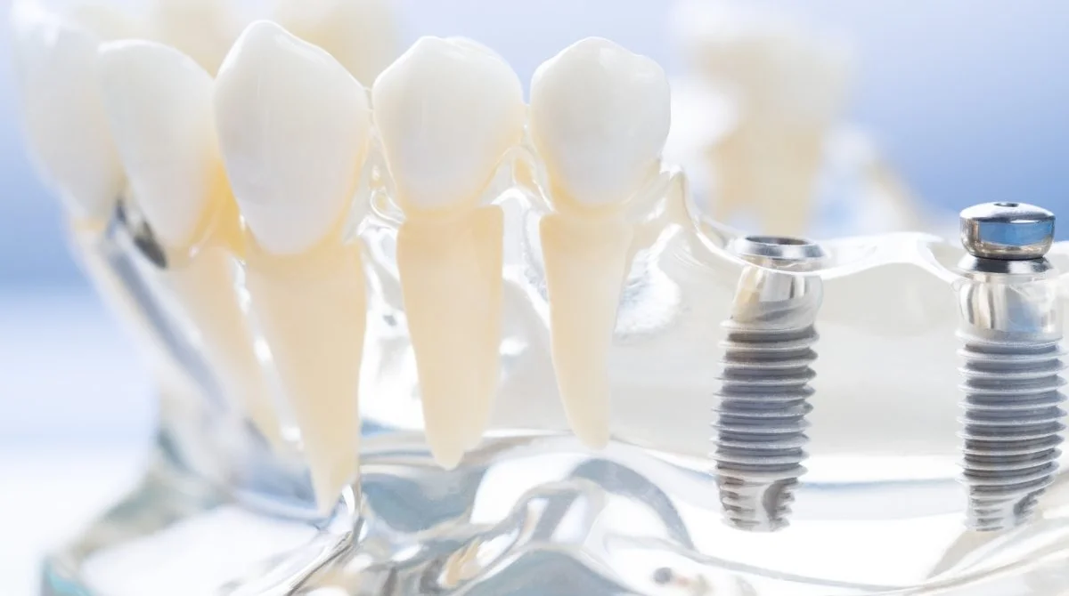 Çorlu'da Tek Seansta İmplant (same-day Implant) Mümkün Mü?