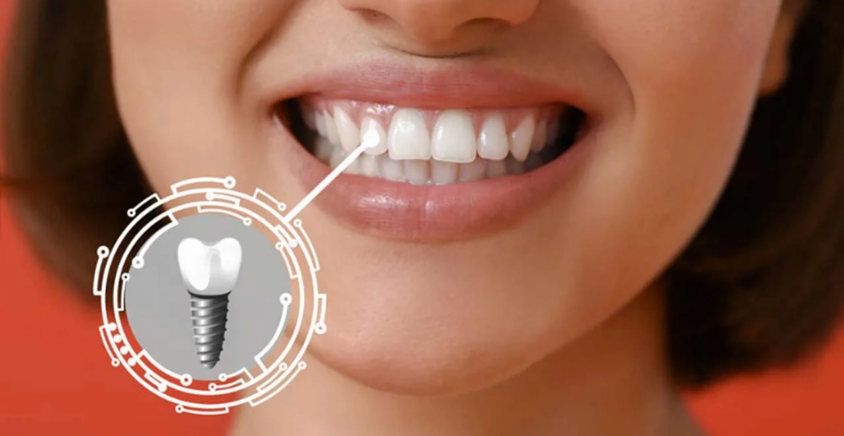 Implant Treatment