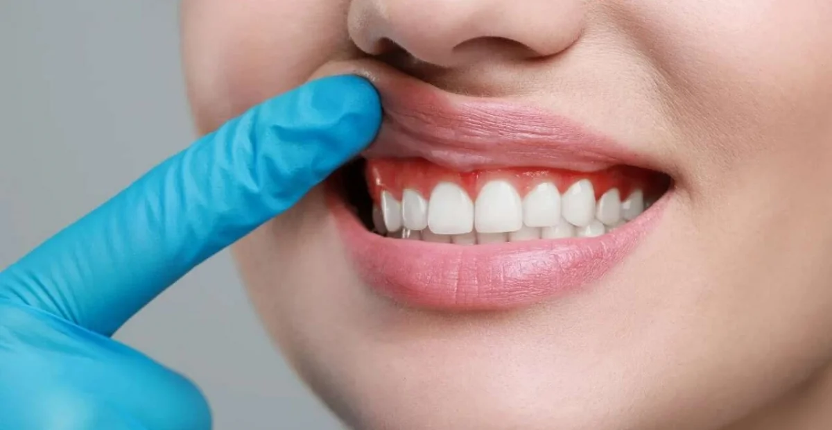 Periodontoloji (Diş Eti Hastalıkları)